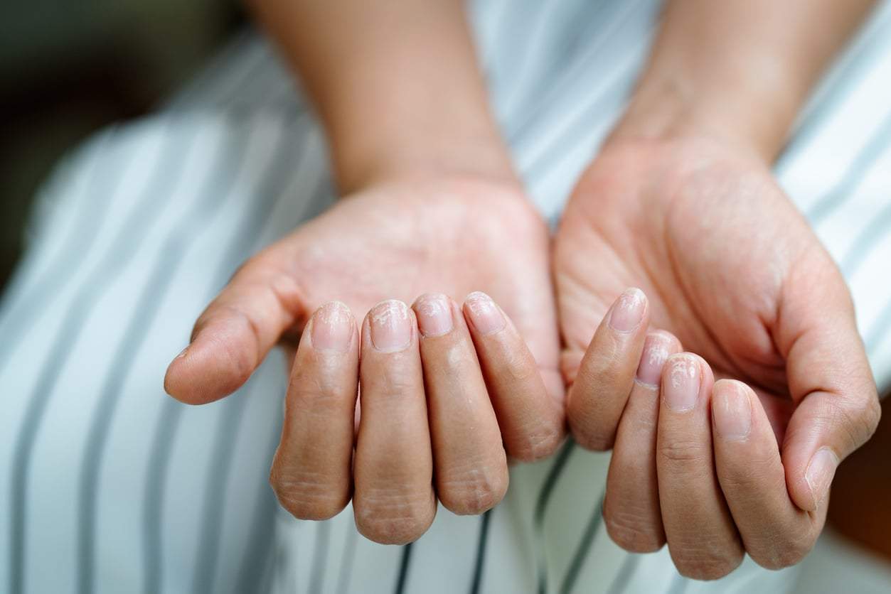 5 nail signs that aren't about vitamin deficiency — they could point to a serious thyroid problem — Health